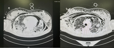 女孩心脏骤停命悬一线,海医一附院重症医学科用ECMO续写生命奇迹