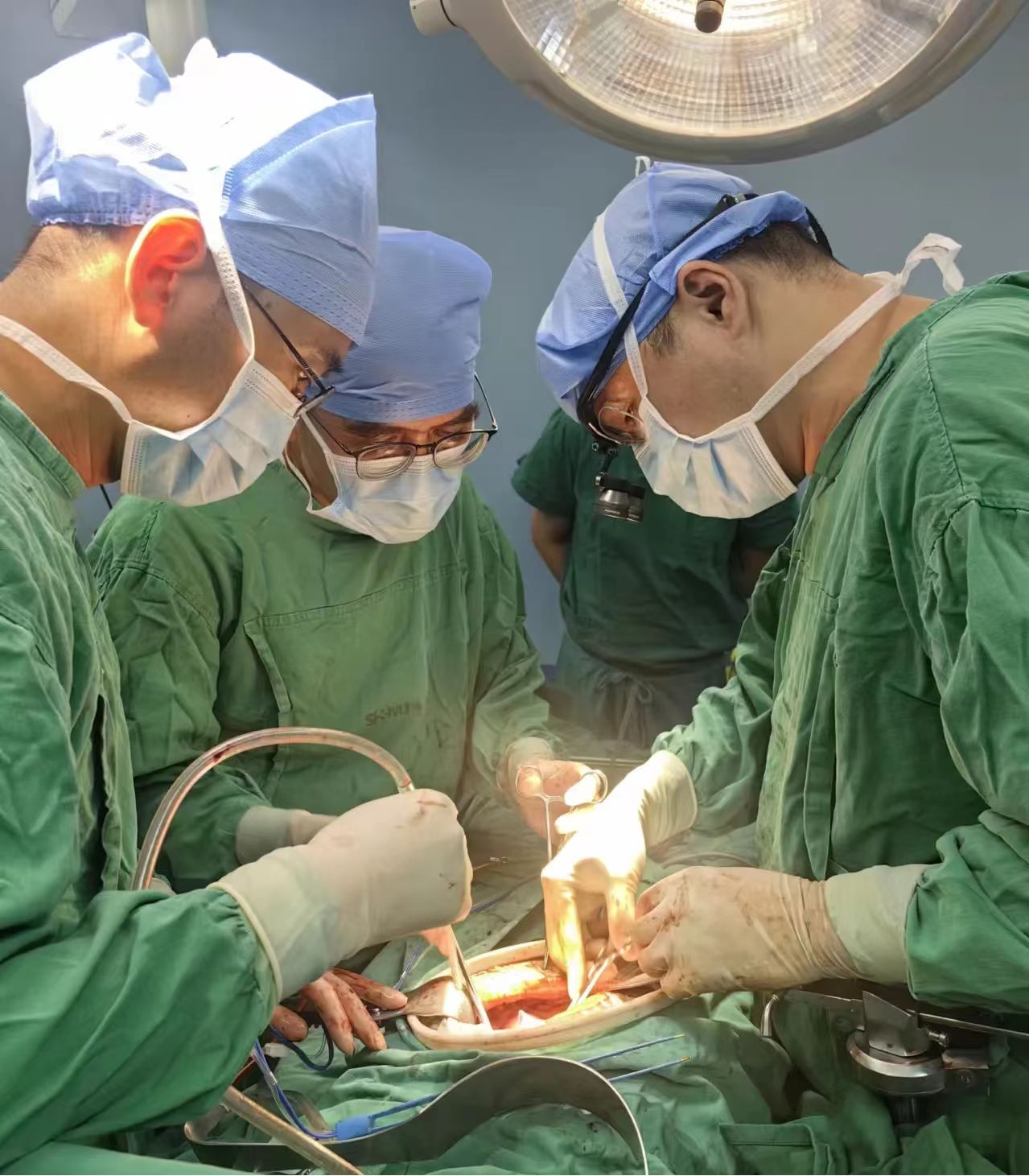 海医二附院首例!肝胆胰外科成功完成左半肝联合胰十二指肠切除术