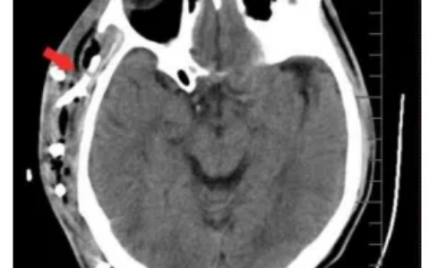 消肿排脓不开刀，海医一附院介入超声来报到！