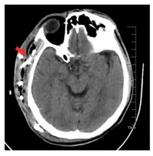 消肿排脓不开刀,海医一附院介入超声来报到!