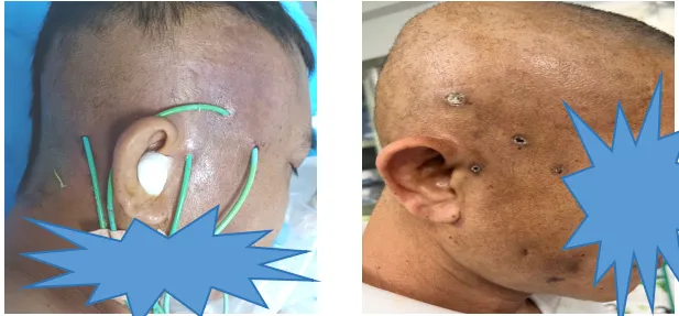 消肿排脓不开刀,海医一附院介入超声来报到!