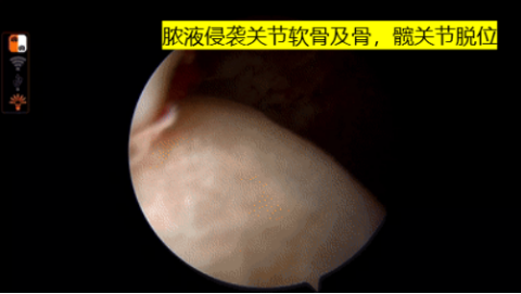 从“搓出来”到“打出来”,海医一附院数字骨科解决复杂髋关节难题