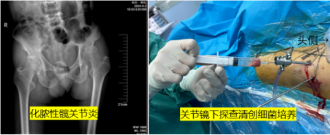 从“搓出来”到“打出来”,海医一附院数字骨科解决复杂髋关节难题