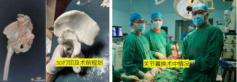 从“搓出来”到“打出来”,海医一附院数字骨科解决复杂髋关节难题