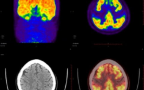 海南首例!“第二代Tau蛋白 PET/CT显像”在解放军总医院海南医院成功开展