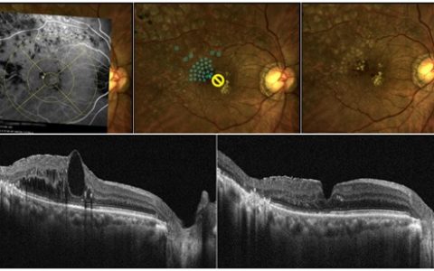 解放军总医院海南医院开展新技术治疗多种眼底疾病