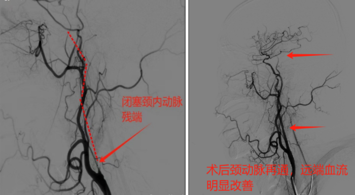 三亚哈医大鸿森医院神经外科完成首例颈动脉慢性闭塞介入再通手术