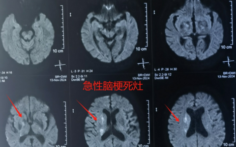 三亚哈医大鸿森医院神经外科完成首例颈动脉慢性闭塞介入再通手术