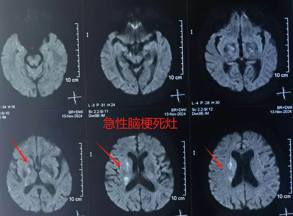 三亚哈医大鸿森医院神经外科完成首例颈动脉慢性闭塞介入再通手术
