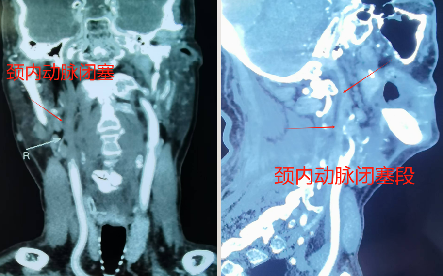 三亚哈医大鸿森医院神经外科完成首例颈动脉慢性闭塞介入再通手术