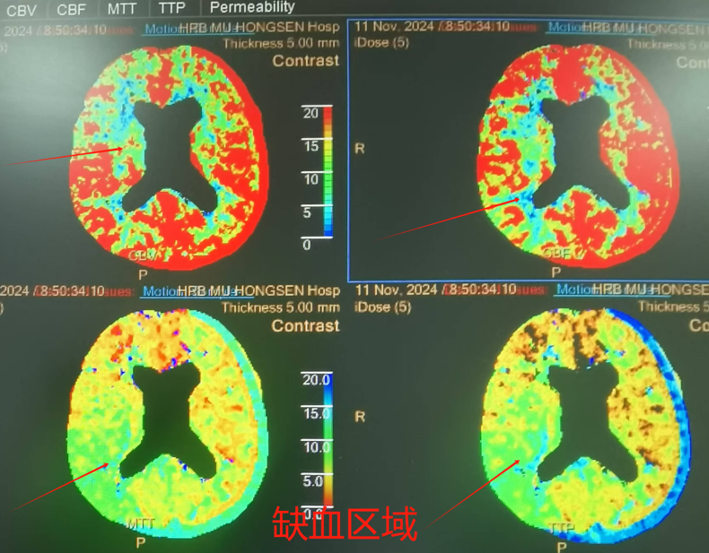 三亚哈医大鸿森医院神经外科完成首例颈动脉慢性闭塞介入再通手术