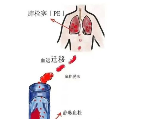 77岁老人突发胸痛、呼吸困难，原来是肺的这个地方堵住了……