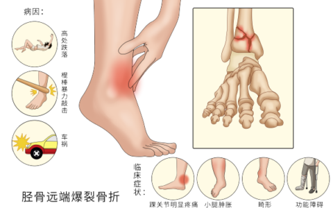 小腿畸形艰辛寻医，关节外科巧用小切口解决大问题！