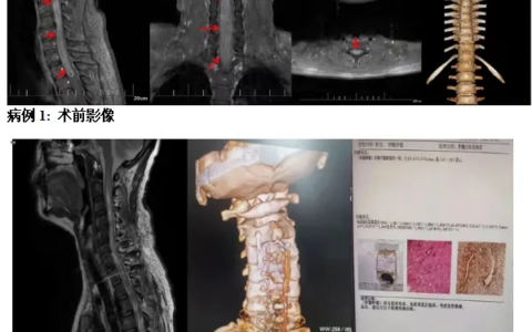 海南医科大学第二附属医院精准定位，护生命之脊——显微镜下的椎管肿瘤切除