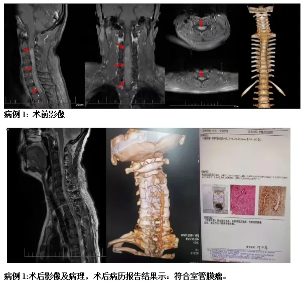 海南医科大学第二附属医院精准定位,护生命之脊——显微镜下的椎管肿瘤切除