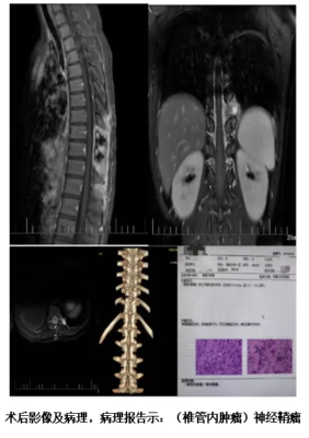 海南医科大学第二附属医院精准定位,护生命之脊——显微镜下的椎管肿瘤切除