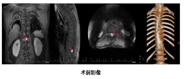 海南医科大学第二附属医院精准定位,护生命之脊——显微镜下的椎管肿瘤切除