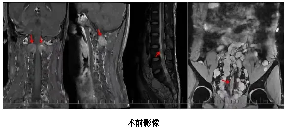 海南医科大学第二附属医院精准定位,护生命之脊——显微镜下的椎管肿瘤切除