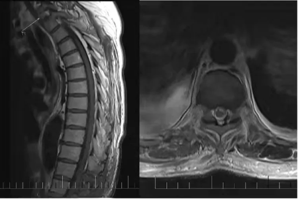 海南医科大学第二附属医院精准定位,护生命之脊——显微镜下的椎管肿瘤切除