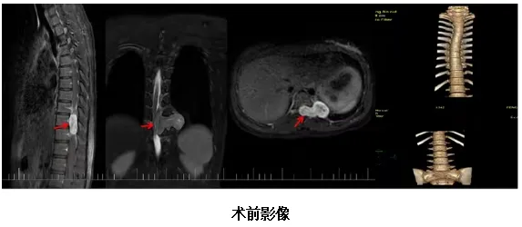 海南医科大学第二附属医院精准定位,护生命之脊——显微镜下的椎管肿瘤切除