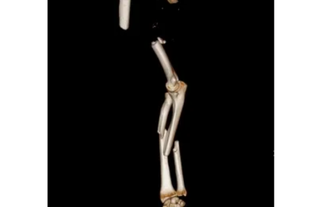 碎石机绞断右手臂，海医二院手足显微外科为患者再植成功