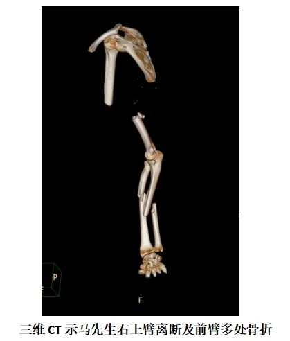 碎石机绞断右手臂，海医二院手足显微外科为患者再植成功