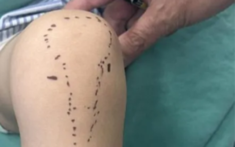 四岁女童玩耍致半月板撕裂，海南省人民医院运动医学科微创关节镜技术巧化解