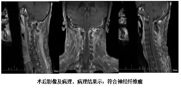 海南医科大学第二附属医院精准定位,护生命之脊——显微镜下的椎管肿瘤切除