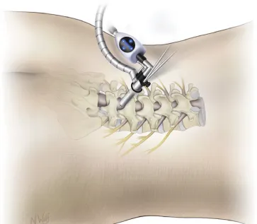 海南首例!神经内镜微创切除椎管内肿瘤,痛苦大大减轻