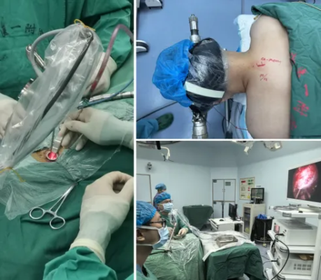 海南首例!神经内镜微创切除椎管内肿瘤,痛苦大大减轻