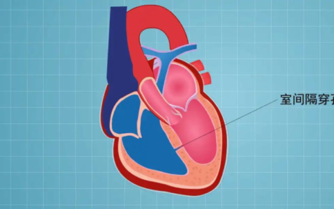 心梗又遇心脏“破洞”，海南省人民医院心血管内科“打针式”微创介入紧急补心