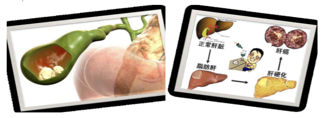 减肥新方案！用于长期体重管理的司美格鲁肽注射液在瑞金海南医院可及