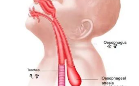 出生仅47天经历2次手术！海南省人民医院多学科联合巧手为食管闭锁宝宝打通“生命通道”