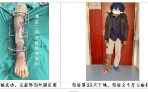 七旬阿公小腿车祸重伤，海医二院手足显微外科全力以赴助其3周下地走路
