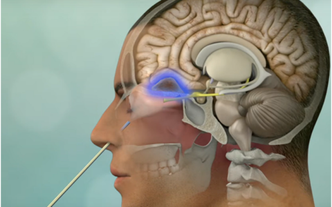 “小切口，大希望”：经鼻内镜切除脑膜瘤新选择