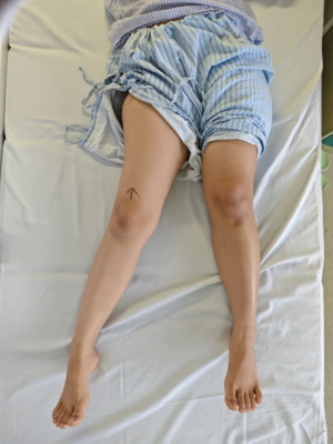 长短腿行走20年！25岁女生在海南省人民医院重获自由步伐
