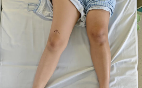 长短腿行走20年！25岁女生在海南省人民医院重获自由步伐