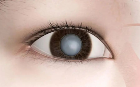 10岁I型糖宝遭遇“视力危机”，多学科联手重启清晰视界！