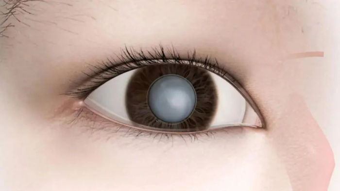 10岁I型糖宝遭遇“视力危机”，多学科联手重启清晰视界！