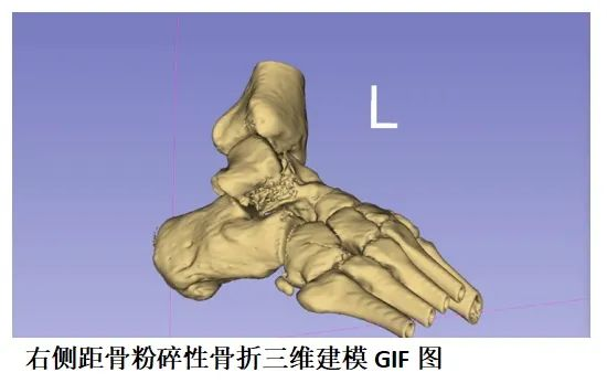 海医二院3D打印辅助骨折术前设计，让手术更精准、更安心！