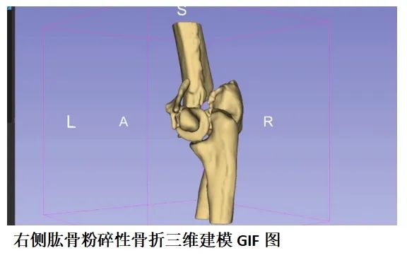 海医二院3D打印辅助骨折术前设计，让手术更精准、更安心！