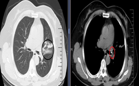一把异物钳！钳去了困扰李大妈半辈子的"咳嗽魔咒"
