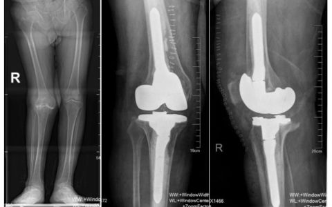 海南医科大学第二附属医院完成高龄类风湿性膝关节炎伴胫骨平台巨大骨缺损全膝关节置换术