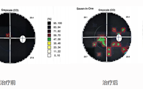 青光眼患者双眼“通电”重获光明——海南医院成功实施一例经颅交流电刺激仪治疗