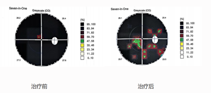青光眼患者双眼“通电”重获光明——海南医院成功实施一例经颅交流电刺激仪治疗