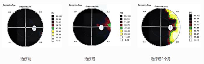青光眼患者双眼“通电”重获光明——海南医院成功实施一例经颅交流电刺激仪治疗