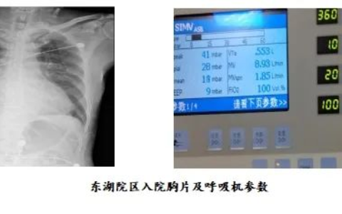 “魔肺“：让呼吸不再窘迫——记海医二院急诊科VV-ECMO成功救治高龄重度ARDS患者一例