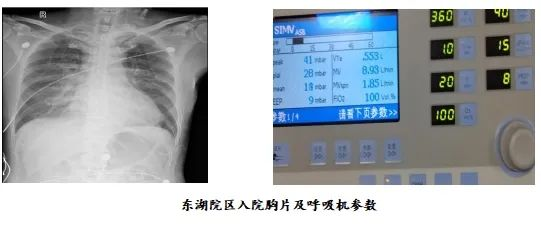 “魔肺“：让呼吸不再窘迫——记海医二院急诊科VV-ECMO成功救治高龄重度ARDS患者一例