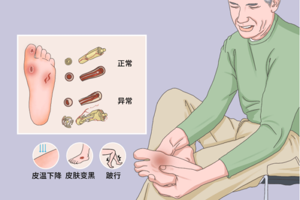 微氧 “黑魔法”，海南医科大学第一附属医院为糖尿病足治愈按下快进键