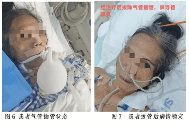 海医二院多学科联手逆转重症肺癌晚期危局 精准狙击“致命杀手”